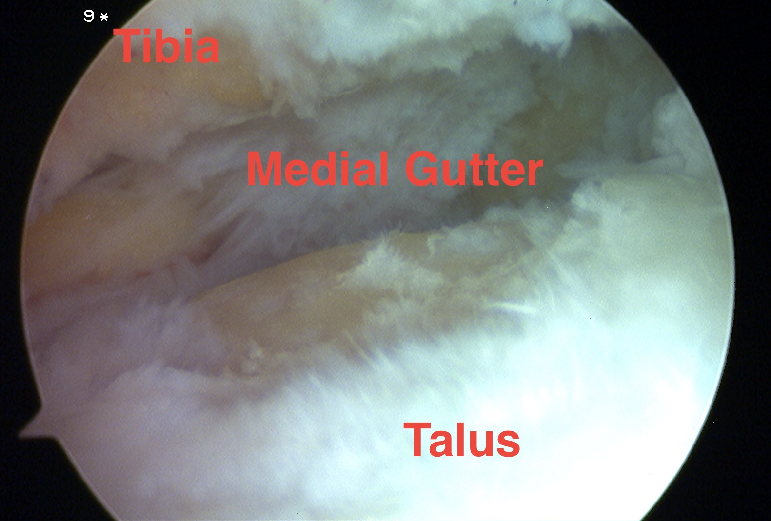 Ankle Arthroscopy Medial Gutter